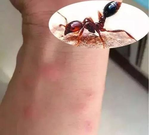 梦见蚂蚁咬手